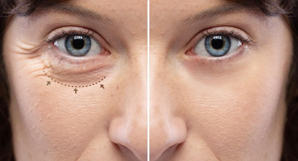 Eyelid Surgery (Blepharoplasty): Benefits, Procedure & Recovery Guide