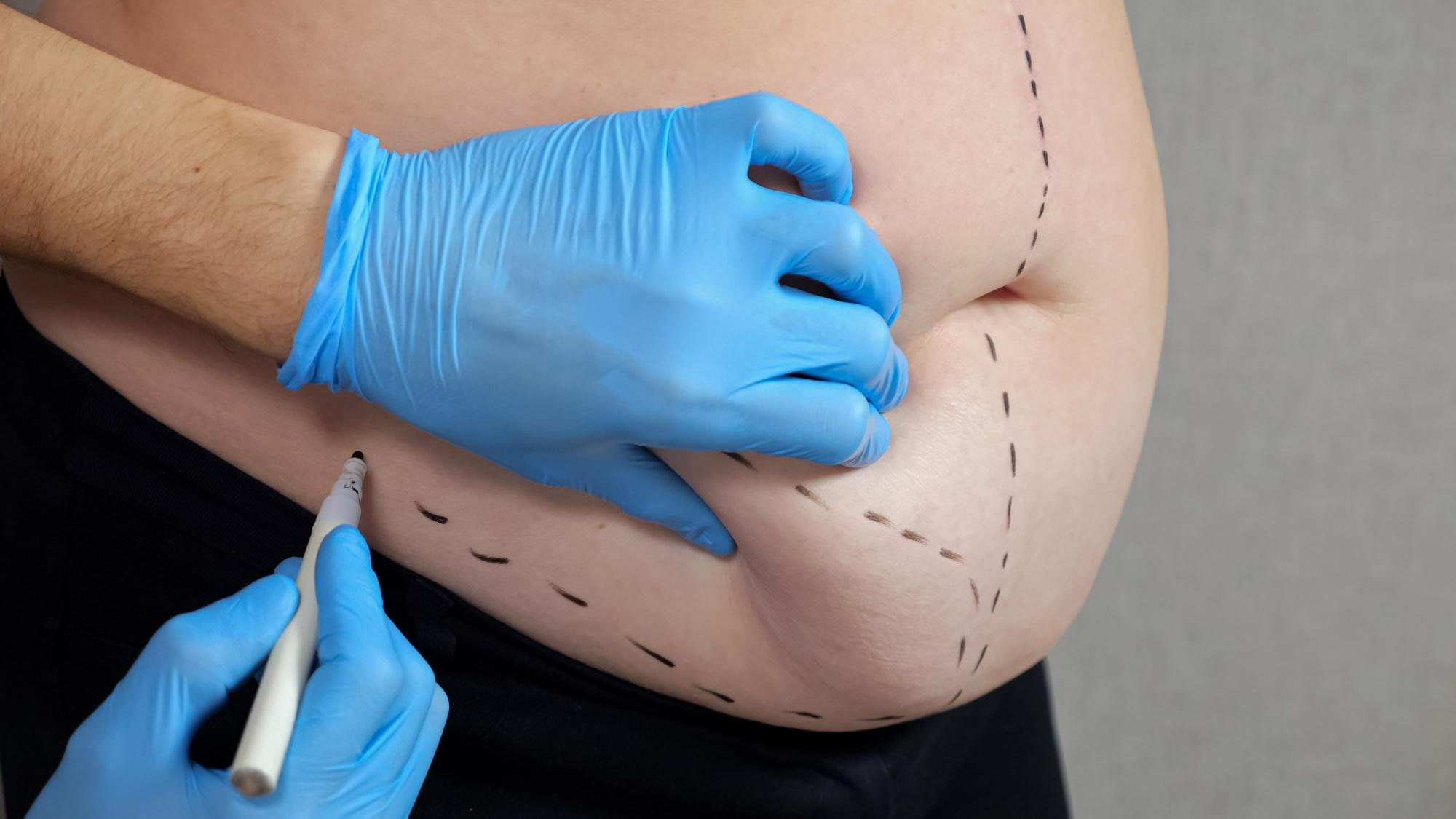 Liposuction procedure
