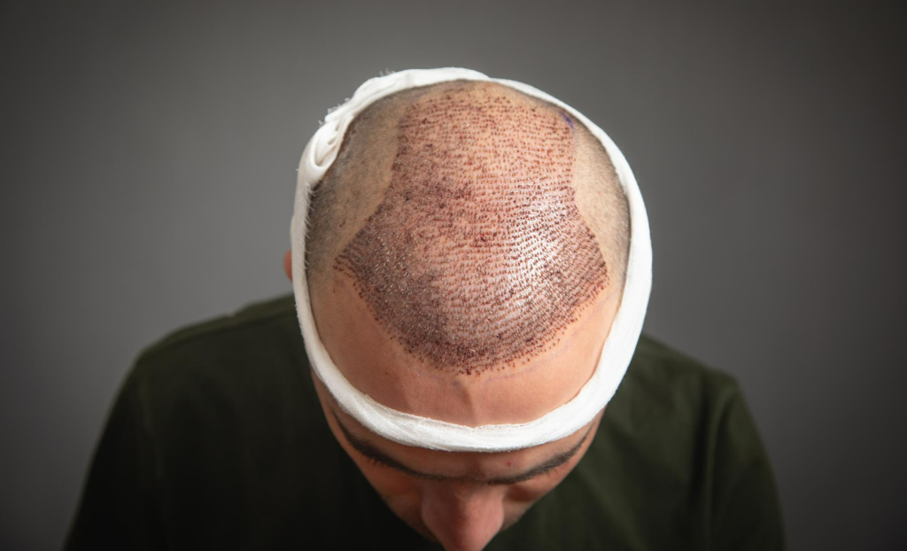 Hair Transplant in Odisha for Men