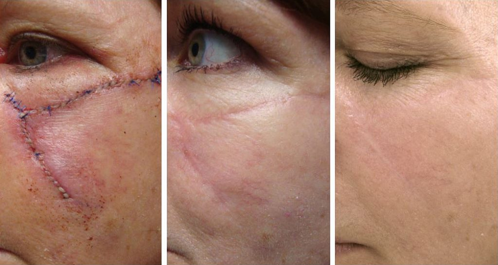 Scar Revision Surgery