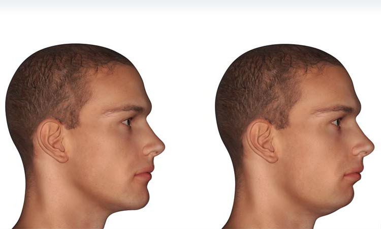 Male Jawline Contouring
