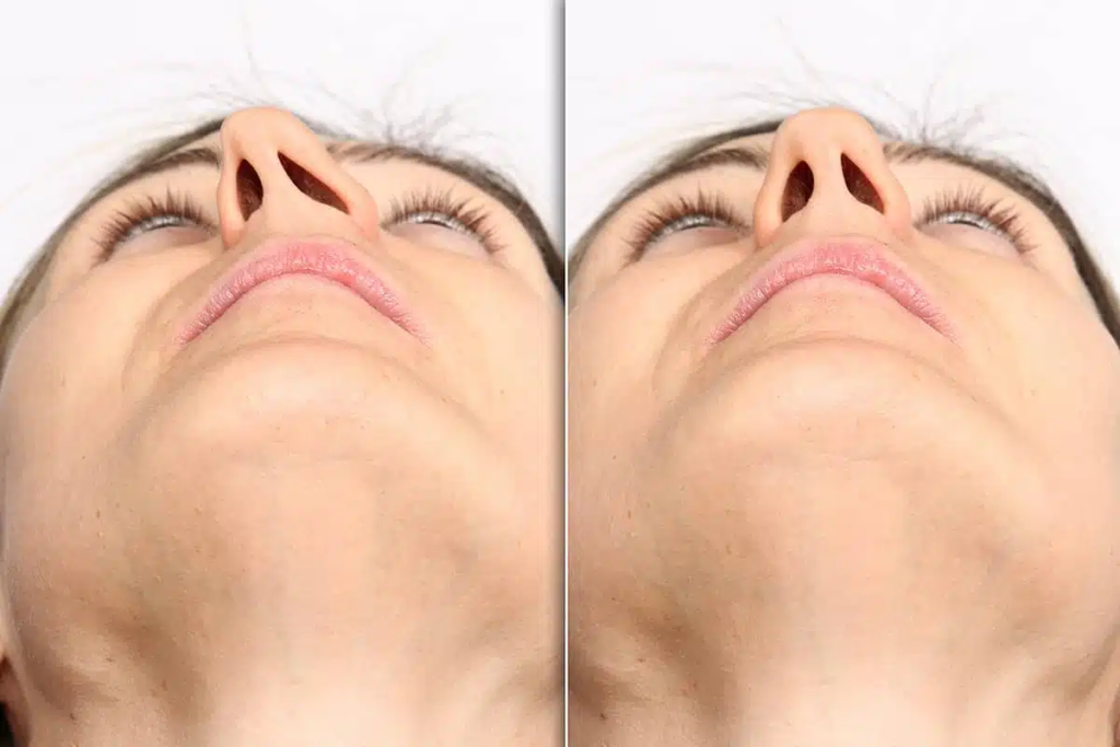 Septoplasty vs Rhinoplasty: Key Differences, Benefits & Which One You Need