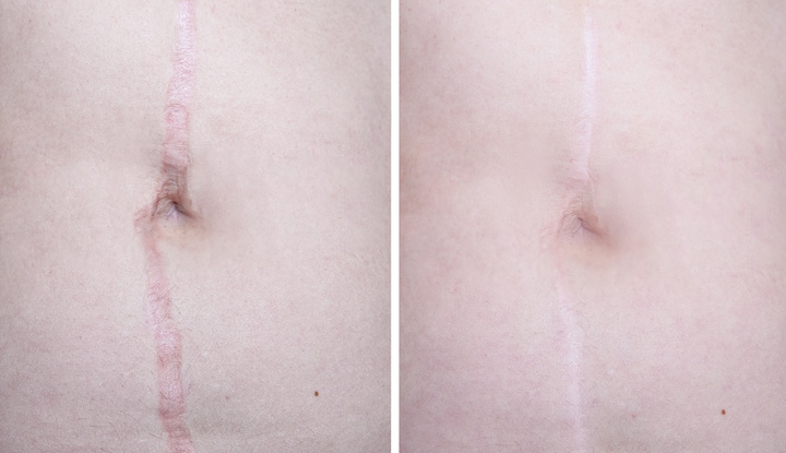 Scar Revision Surgery