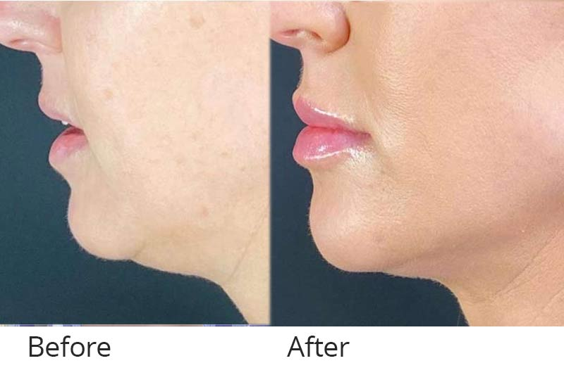Liquid Facelift