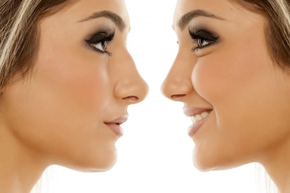 Top Benefits of Rhinoplasty