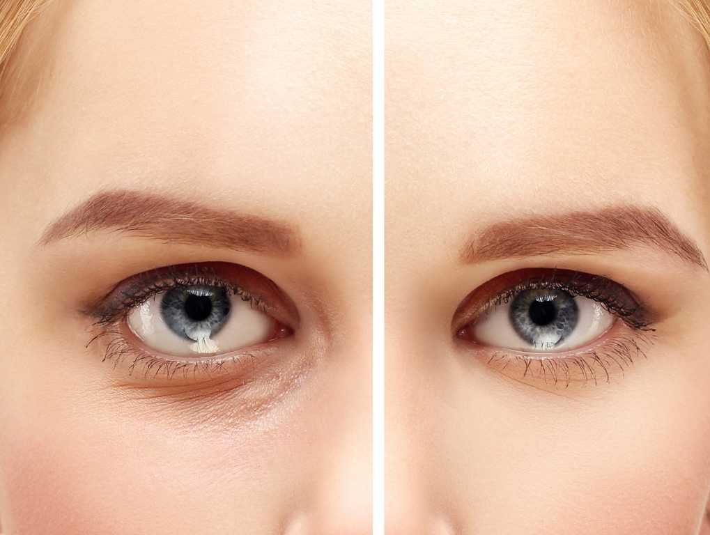 eyelid-surgery-blepharoplasty-youthful-look