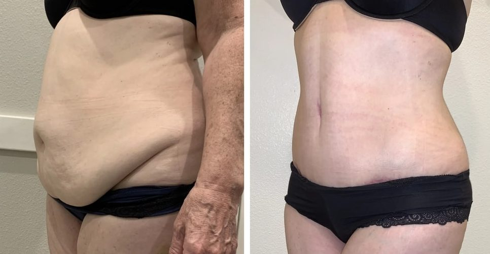 Tummy Tuck vs Liposuction: Which Procedure Is Right for You?