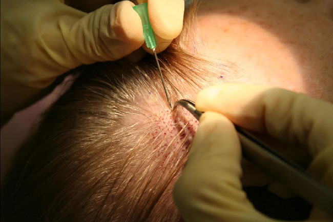 Bio-Integrated FUE Hair Transplant