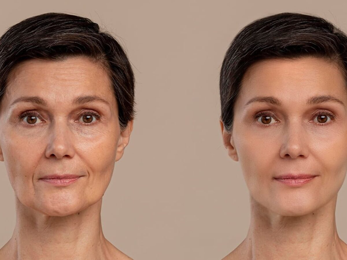 when can I return to work after a facelift