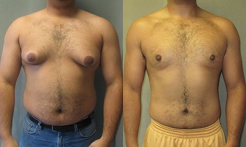 Gynecomastia vs chest fat