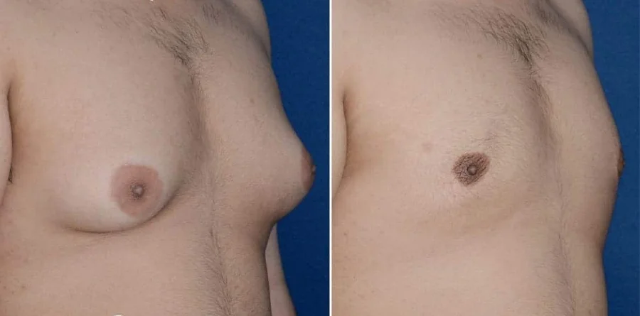 Gynecomastia vs Chest Fat