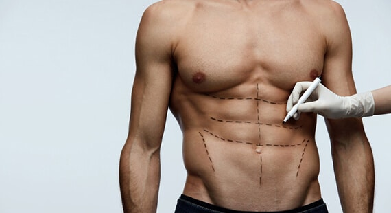 Six-Pack Liposuction (Hi-Def Lipo): Is It Right for You?