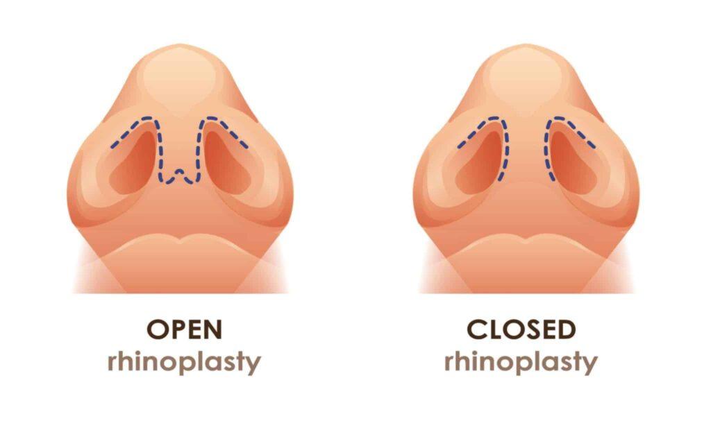 Open vs Closed Rhinoplasty: Which Technique Is Better? | OCSC