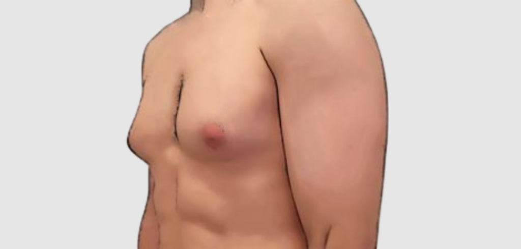 Grade 1 vs Grade 4 Gynecomastia: Which Needs Surgery?