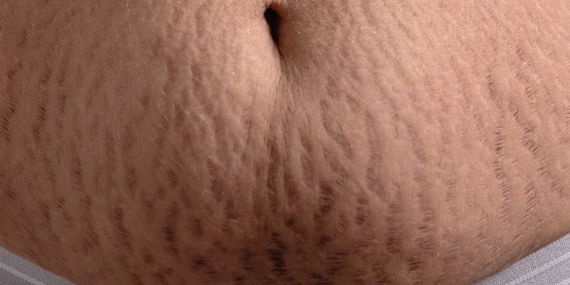 Stretch Mark Treatments