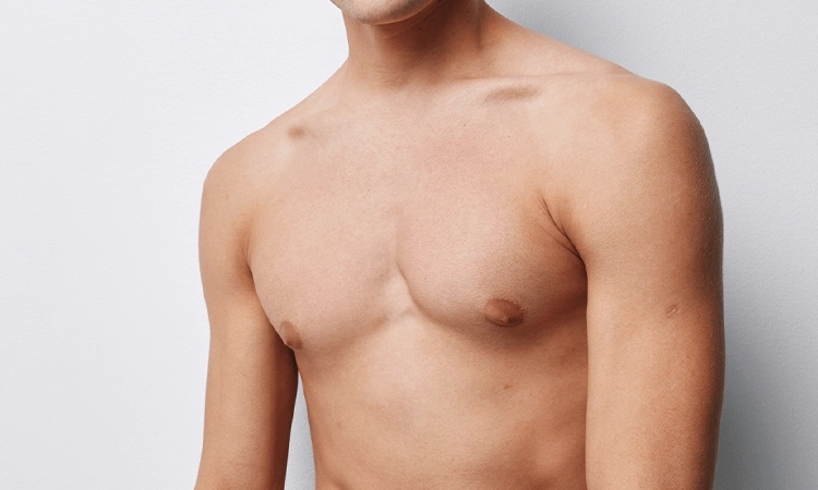 Gynecomastia recurrence after surgery