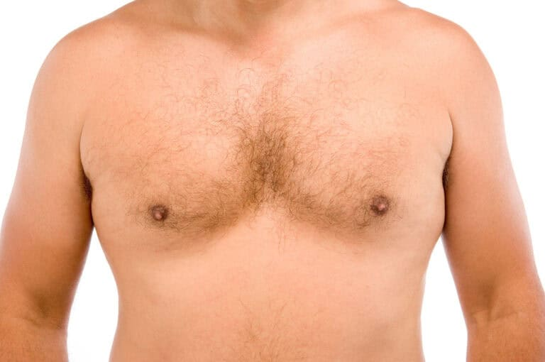 Is Gynecomastia Surgery Permanent? Results, Recovery & FAQs