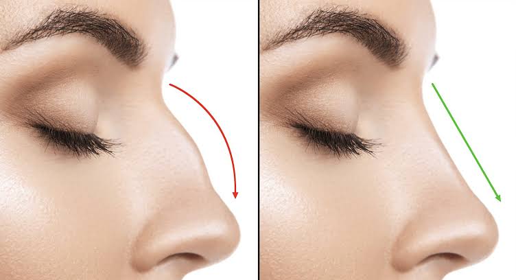 Rhinoplasty: Consultation, Surgery, Recovery & Results