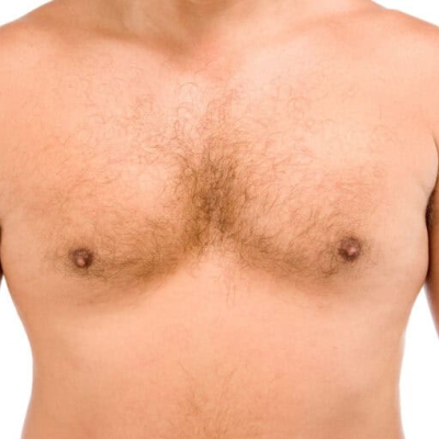 Is Gynecomastia Surgery Permanent? Results, Recovery & FAQs