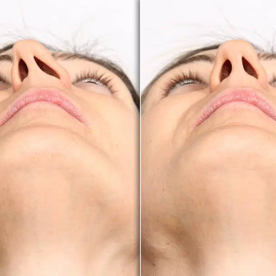 Septoplasty vs Rhinoplasty: Key Differences, Benefits & Which One You Need