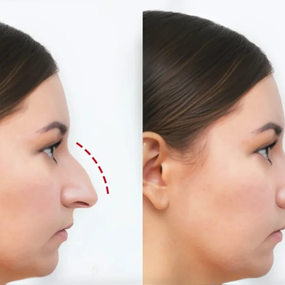 Bulbous Nose Correction: Can Surgery Refine a Round Nasal Tip?