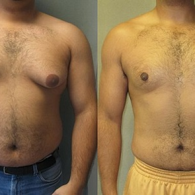 Gynecomastia vs chest fat