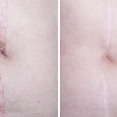 Scar Revision Surgery