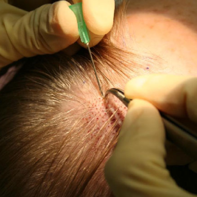 Bio-Integrated FUE Hair Transplant