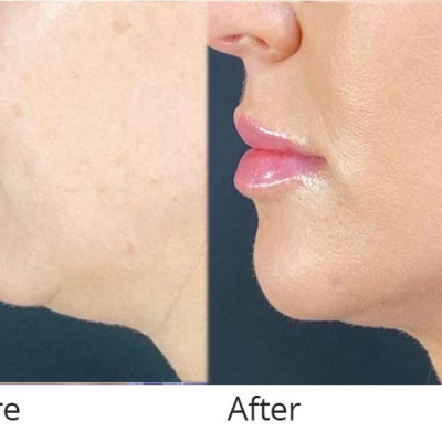 Liquid Facelift