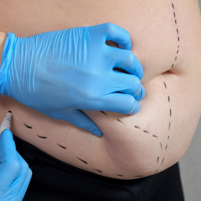 Liposuction procedure