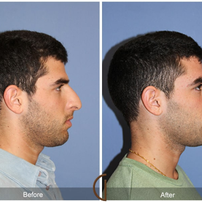 Can Men Get Rhinoplasty? Male Nose Surgery Explained