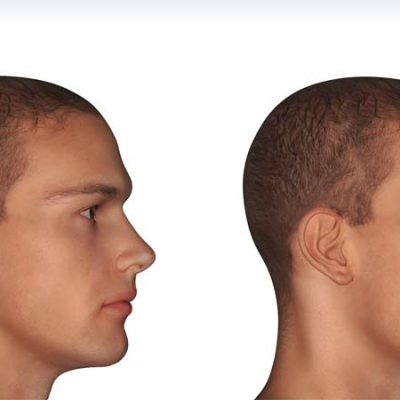 Male Jawline Contouring
