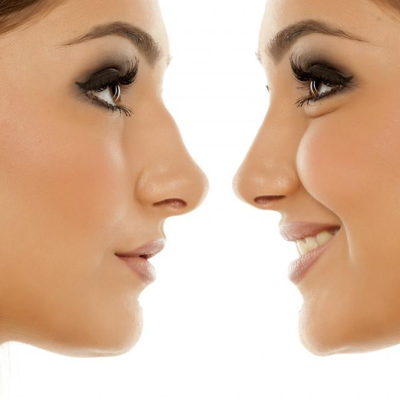 Top Benefits of Rhinoplasty