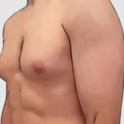 Grade 1 vs Grade 4 Gynecomastia: Which Needs Surgery?