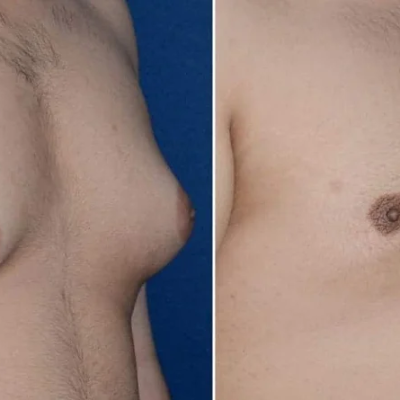 Gynecomastia vs Chest Fat