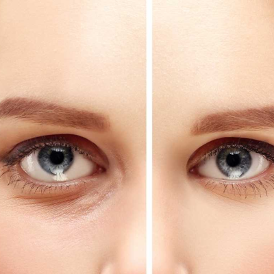 eyelid-surgery-blepharoplasty-youthful-look