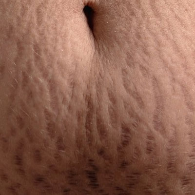 Stretch Mark Treatments