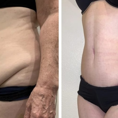 Tummy Tuck vs Liposuction: Which Procedure Is Right for You?