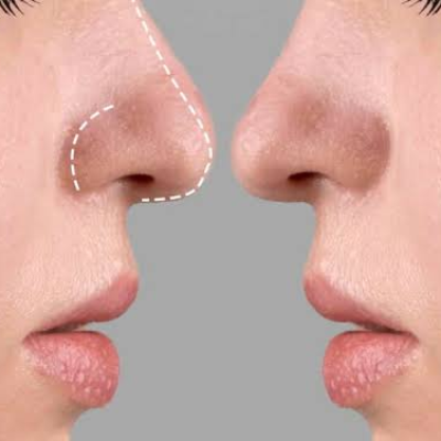 Can Rhinoplasty Fix a Deviated Septum & Improve Breathing?