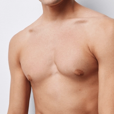 Gynecomastia recurrence after surgery