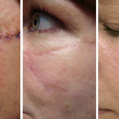 Scar Revision Surgery