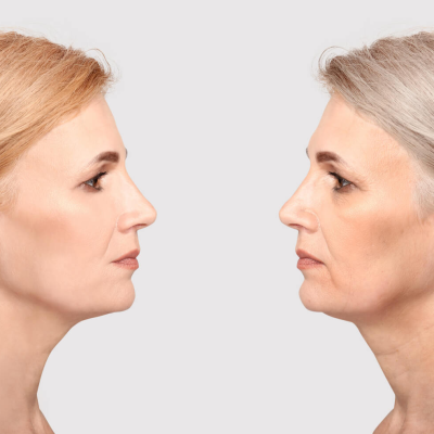 Anti-Aging Treatments: Surgical vs Non-Surgical Options Explained