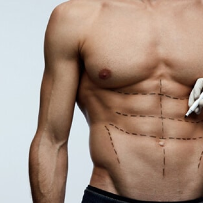 Six-Pack Liposuction (Hi-Def Lipo): Is It Right for You?