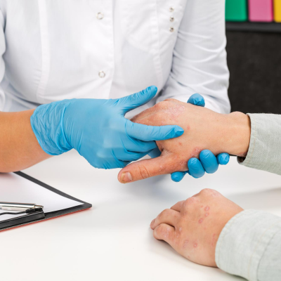 Burns: Initial Assessment and Management Guide for First Aid and Emergency Care