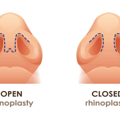 Open vs Closed Rhinoplasty: Which Technique Is Better? | OCSC